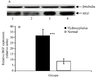 Image for - Cerebrospinal Fluid Hepatocyte Growth Factor Levels in the Children with Congenital Non-communicating Hydrocephalus