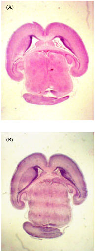 Image for - Maternal Diabetes Induced Hydrocephaly in Newborn Rats