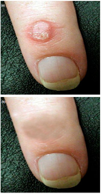 Image for - Miraculous Effect of Smoke of Pine Tree Fruit on Human Wart Treatment: A  Case Series