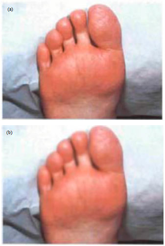 Image for - Miraculous Effect of Smoke of Pine Tree Fruit on Human Wart Treatment: A  Case Series