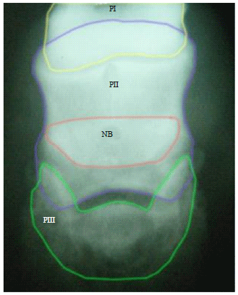 Image for - A Study of the Effects of Desmotomy of the Navicular Bone Suspensory Ligament on Radio-Morphometric Features of the Navicular Bone in Normal Donkeys (Equus asinus)
