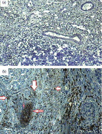 Image for - CD14 Expression and Microbial Infection in Bladder Tumours