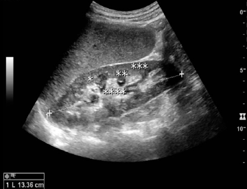Image for - Real Time Brightness Mode Ultrasound in Determining the Causes and Complications of Obstructive Uropathy