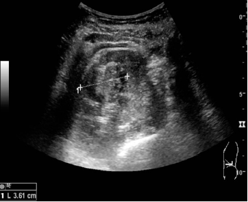 Image for - Real Time Brightness Mode Ultrasound in Determining the Causes and Complications of Obstructive Uropathy