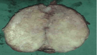 Image for - Unifocal Brown Tumor of Tibia: An Unusual Presentation
