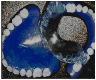 Image for - Conservative Treatment of Temporomandibular Joint Meniscus Perforations