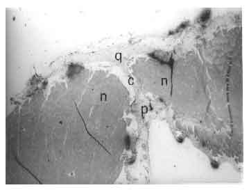 Image for - Processed Bovine Tunica Vaginalis as a Biomaterial for the Repair of Large Abdominal Wall Defects in Surgical Treatment