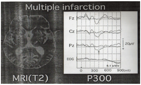 Image for - Latency Prolongation of P300 Event Related Potentials in Patients with and Without Asymptomatic Cerebral Infarction