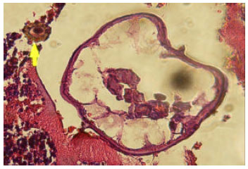 Image for - Concomitant Infection of Appendix with Taenia and Enterobius vermicularis