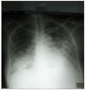 Image for - Mitochondrial Encephalomyopathy Presenting with Respiratory Failure in an Adult