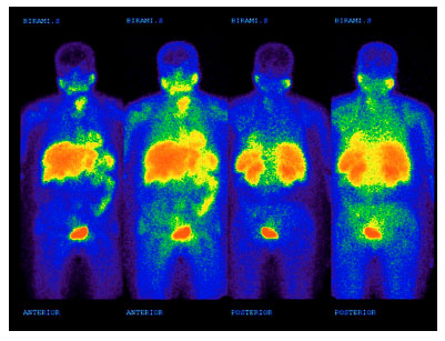 Image for - 99mTc-MIBI Scintigraphy Versus 131I Whole Body Scan in the Follow-up of Patients with Differentiated Thyroid Carcinoma