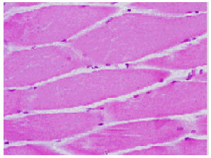Image for - Mitochondrial Encephalomyopathy Presenting with Respiratory Failure in an Adult