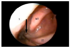 Image for - Role of Intraoperative Endoscopic Sphenopalatine  Ganglion Block in Sinonasal Surgery