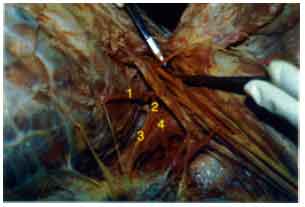 Image for - Variation in Axillary Artery Branches (A Case Report)