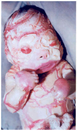 Image for - Harlequin Baby (A Case Report)