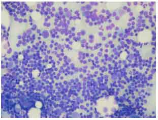 Image for - Hemorrhagic Pleural Effusion as a First Presentation of Chronic Lymphocytic Leukemia (A Case Report)