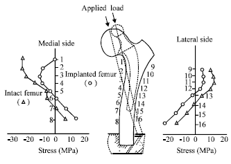 Image for - Problem of Stress Shielding and Improvement to the Hip Implant Designs: A Review