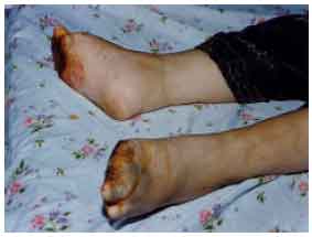 Image for - Scleroderma and Renal Crisis