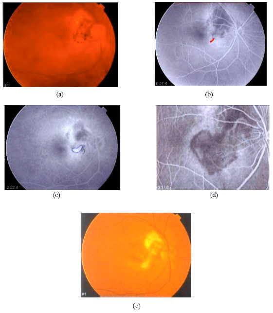 Image for - Efficacy of TTT (Transpupillary Thermotherapy) in Treatment of Myopic Subretinal Choroidal Neovascular Membranes (SNVMs)