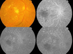 Image for - High Dietary Fibre Intake (Talbina) as Adjunct in the Management of Diabetic Macular Edema