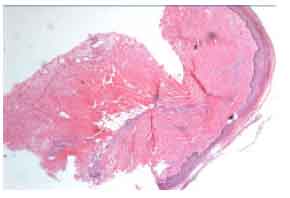 Image for - Scleroderma and Renal Crisis