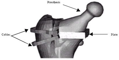 Image for - Problem of Stress Shielding and Improvement to the Hip Implant Designs: A Review