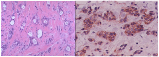 Image for - Histopathological and Immunohistochemical Study of E-cadherin in Breast Neoplasia