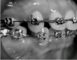Image for - Crevicular Alkaline Phosphatase Activity During Orthodontic Tooth Movement: Canine Retraction Stage