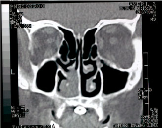 Image for - Malignant Fibrous Histiocytoma Arising from Nasal Cavity