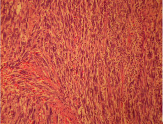 Image for - Malignant Fibrous Histiocytoma Arising from Nasal Cavity