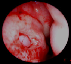 Image for - Inferior Turbinate Flap Combined with Septal Cartilage Interpositional Graft for Repair of Nasal Septal Perforation