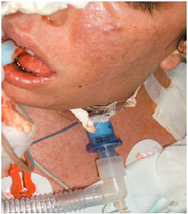 Image for - Emergent Tracheostomy in Two Patients with Acute Leukemia: Comparing Surgical and Percutaneous Methods