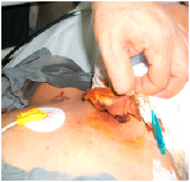 Image for - Emergent Tracheostomy in Two Patients with Acute Leukemia: Comparing Surgical and Percutaneous Methods