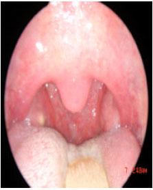 Image for - Posterior Pillar Flap Palatoplasty: A New Surgical Technique for Treatment of Snoring: Initial Experience