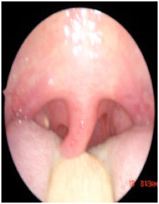 Image for - Posterior Pillar Flap Palatoplasty: A New Surgical Technique for Treatment of Snoring: Initial Experience