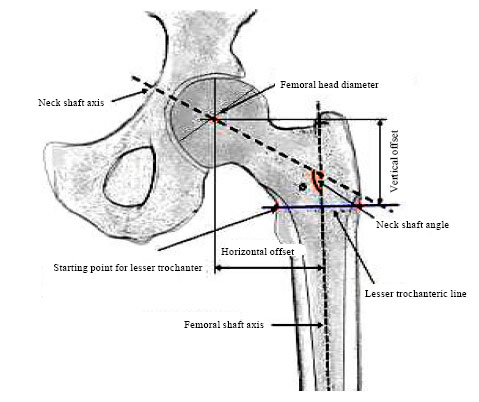 Image for - Prediction of Femur Bone Geometry using Anthropometric Data of Indian Population: A Numerical Approach