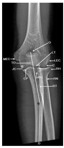 Image for - Radiographic Evaluation of the Normal Elbow Carrying Angle in Adults