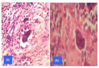 Image for - Angulated Giant Cell with Clefting: A Clue to the Diagnostic Dilemma of Nodular Tenosynovitis