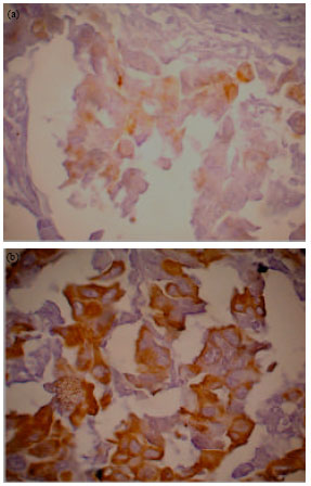 Image for - Association of VEGF with Regional Lymph Node Metastasis in Breast IDC