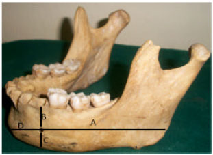 Variations in the Mandibular Foramina of Yoruba Ethnic Group of Nigeria