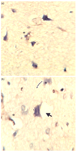 Image for - Immunohistochemical Localization of Neuron Specific Enolase and CD3 Lymphocyte Activation
