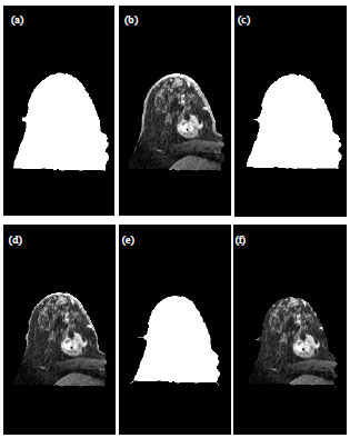 Image for - MRI Breast Skin-line Segmentation and Removal using Integration Method of Level Set Active Contour and Morphological Thinning Algorithms