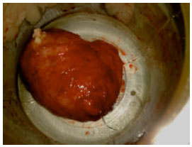 Image for - Cesarean Myomectomy: A Case Report in Zainoel Abidin General Hospital, Banda Aceh