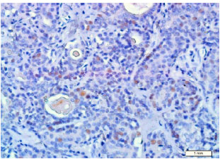 Image for - Expression of CDK6 in Salivary Gland Tumors