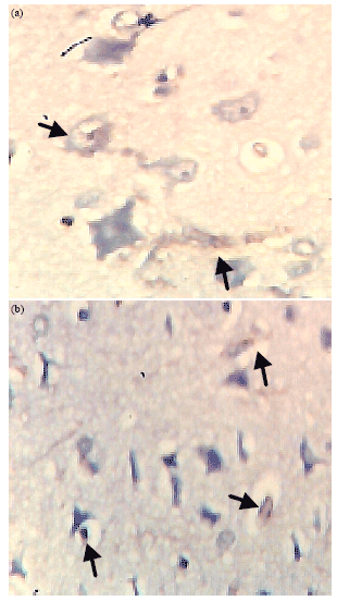Image for - Immunohistochemical Localization of Neuron Specific Enolase and CD3 Lymphocyte Activation