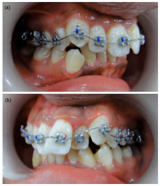 Image for - Evaluation of the Efficacy of Fluoride Varnish on Enamel Demineralization in Orthodontic Patients: A Split-mouth Clinical Trial