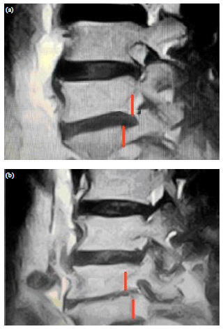 Image for - Correlation of Axial Vertebral Rotation with Nerve Root Involvement: The First Clinical Study in Literature
