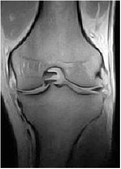 Image for - “Floating Meniscus” a Specific Indicator of Anterior Cruciate Ligament Rupture