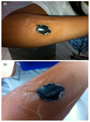 Image for - Wound Infection Caused by Pseudallescheria boydi with Black Discharge: A Case Report