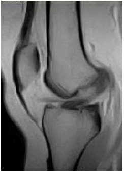Image for - “Floating Meniscus” a Specific Indicator of Anterior Cruciate Ligament Rupture